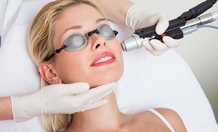 cum se realizează procedura de întinerire a pielii cu laser 